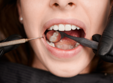 Tooth-Colored Fillings